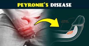 Understanding Peyronie’s Disease: A Comprehensive Overview